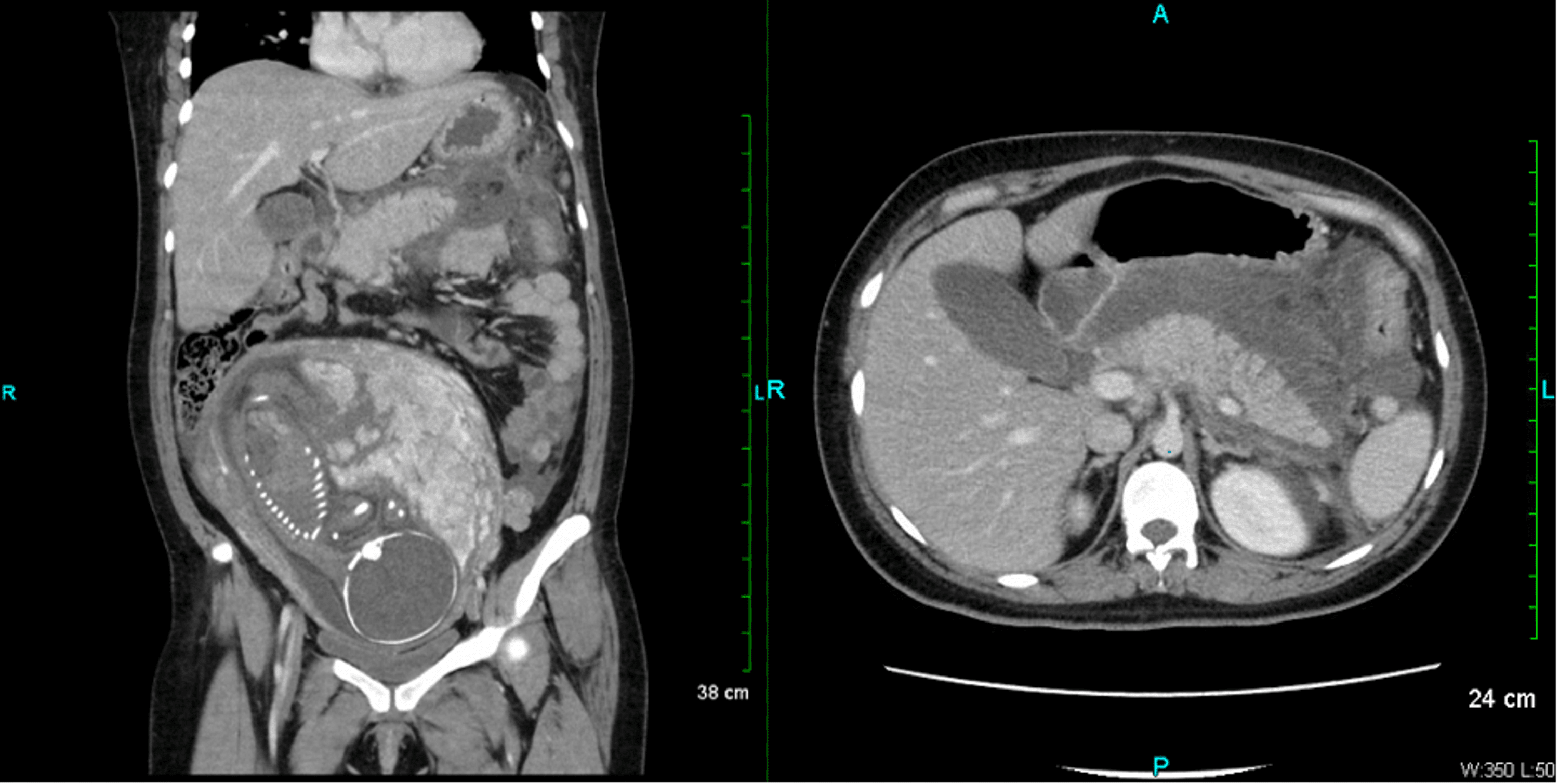 Cureus HypertriglyceridemiaInduced Acute Pancreatitis During