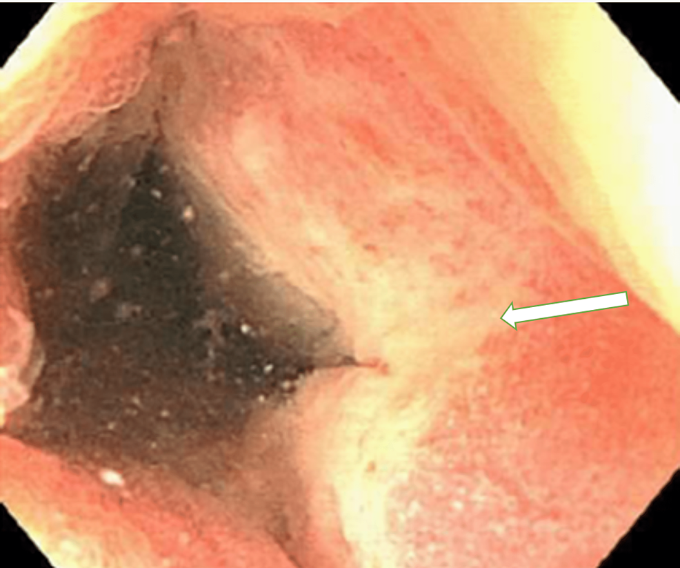 Colonoscopy-of-the-distal-transverse-colon-with-abnormal-mucosa-