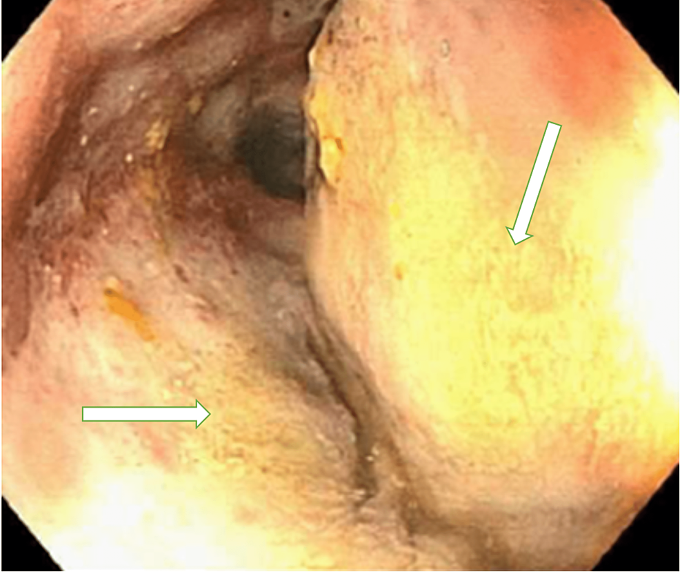 Colonoscopy-of-the-distal-transverse-colon-with-ulcerated-mucosa