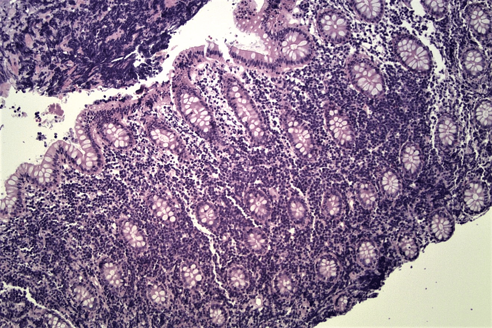 Histologic-section-of-colonic-mucosa-with-H&E-stain-(original-magnification,-x-200).