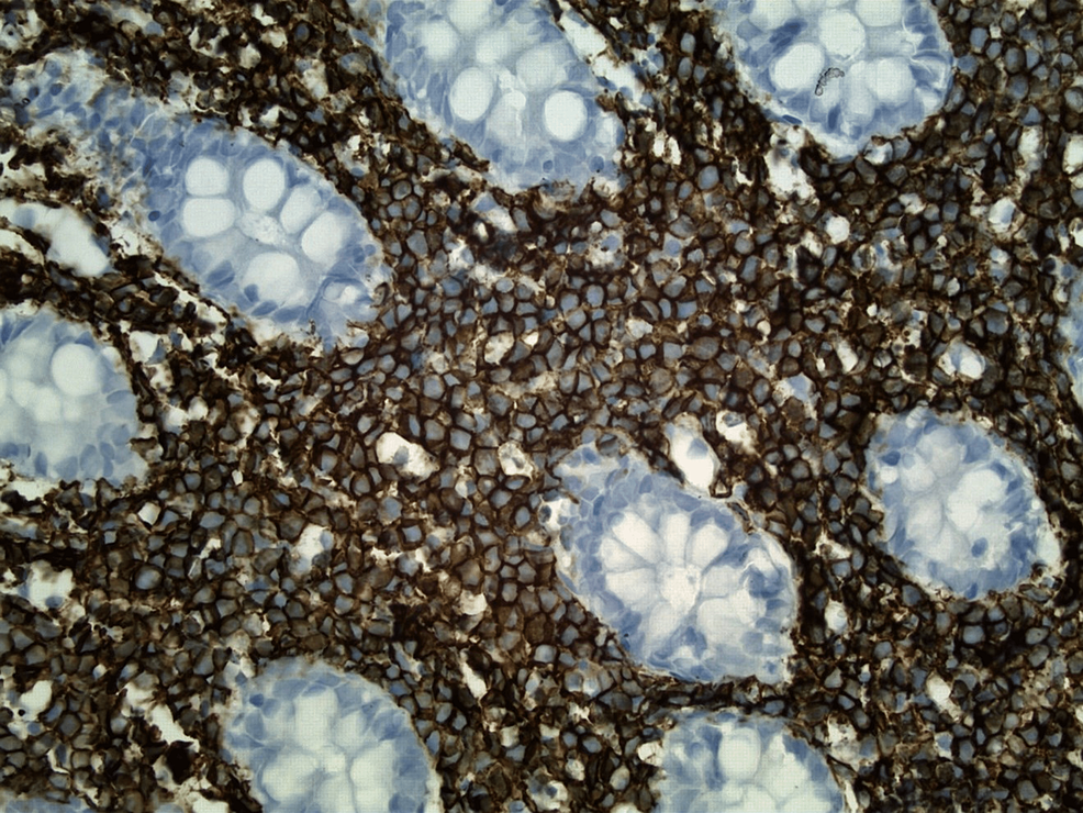 Histologic-section-of-colonic-mucosa-with-CD20-immunohistochemical-stain-(original-magnification,-x-400)