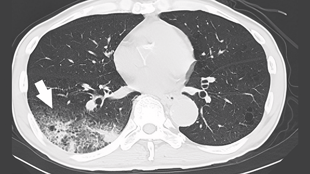 Results-of-chest-computed-tomography-(day-1)-showing-right-lower-lobe-infiltration