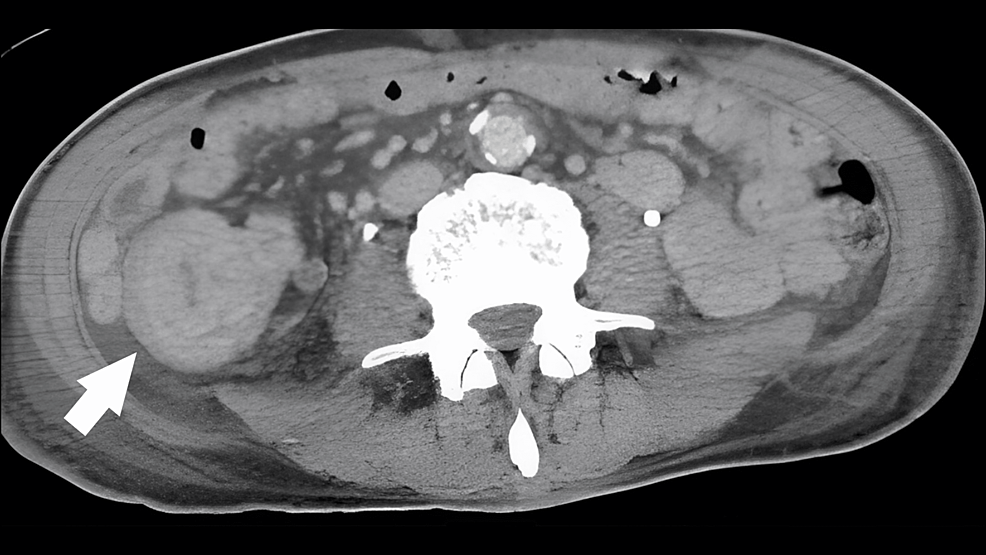 Abdominal-computed-tomography-showing-a-mass-in-the-right-lower-abdomen