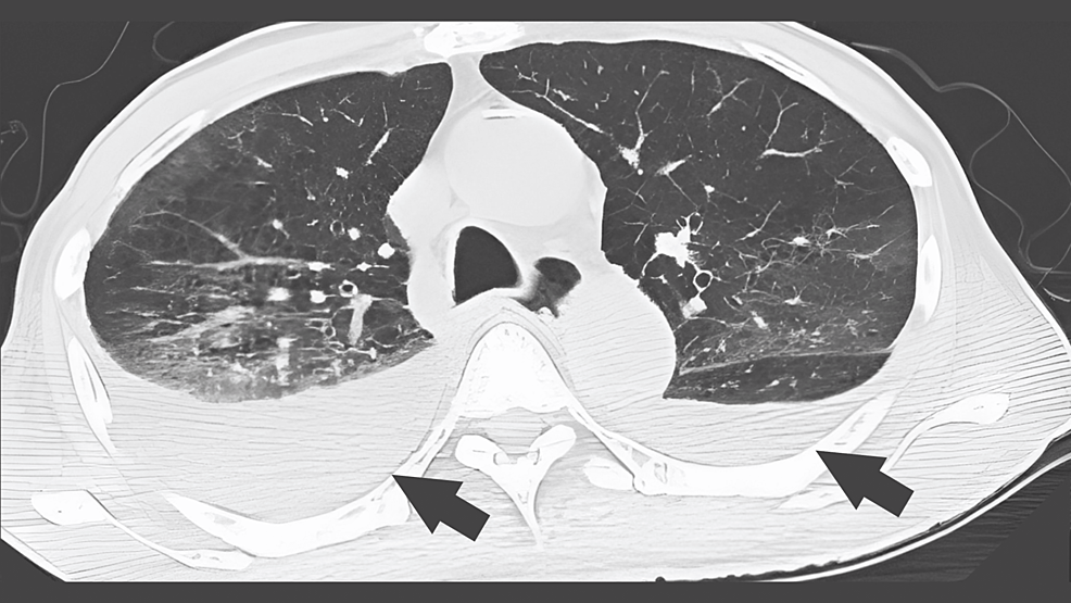 -Chest-computed-tomography-showing-the-bilateral-lung-frosted-shadows-and-pleural-effusions.