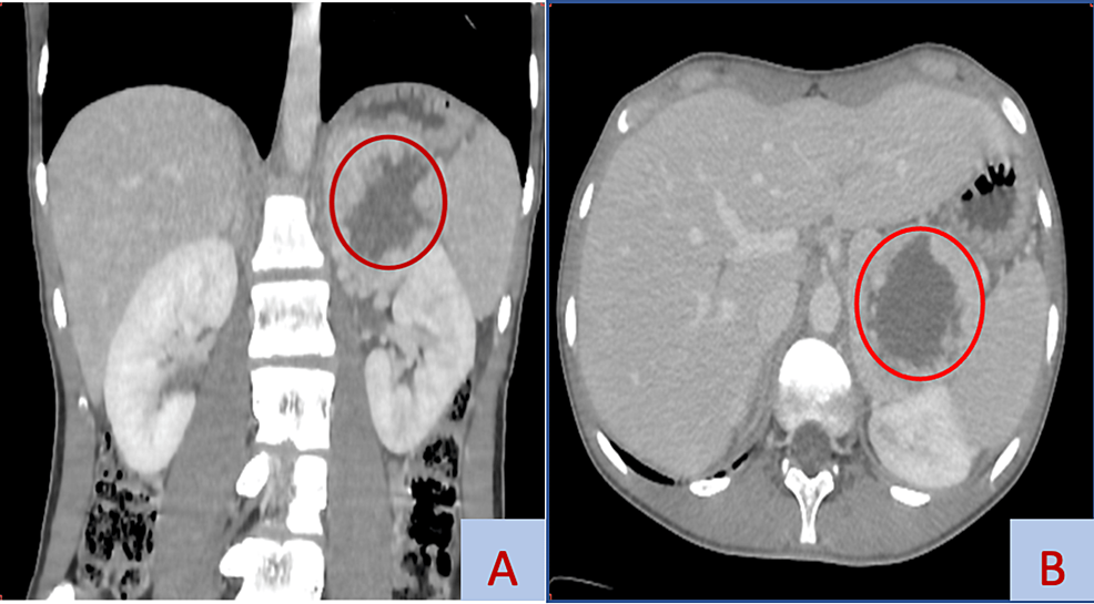 Cureus | Noradrenergic Pheochromocytoma: A Case Report