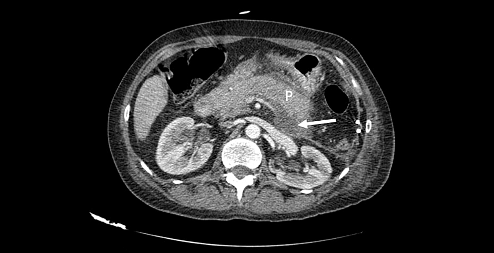 Abdominal-computed-tomography-with-contrast-showing-acute-pancreatitis-with-diffuse-swelling-of-the-pancreas-(P)-and-retropancreatic-fluid-collection-with-no-signs-of-necrosis-(arrow).