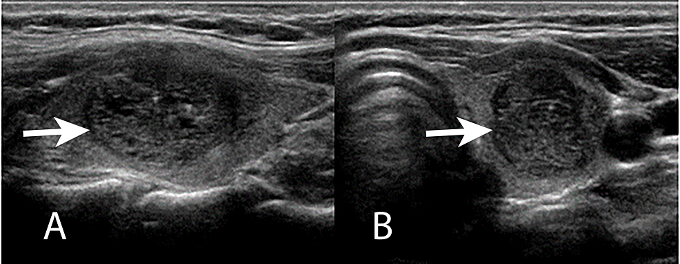 Left-thyroid-ultrasound