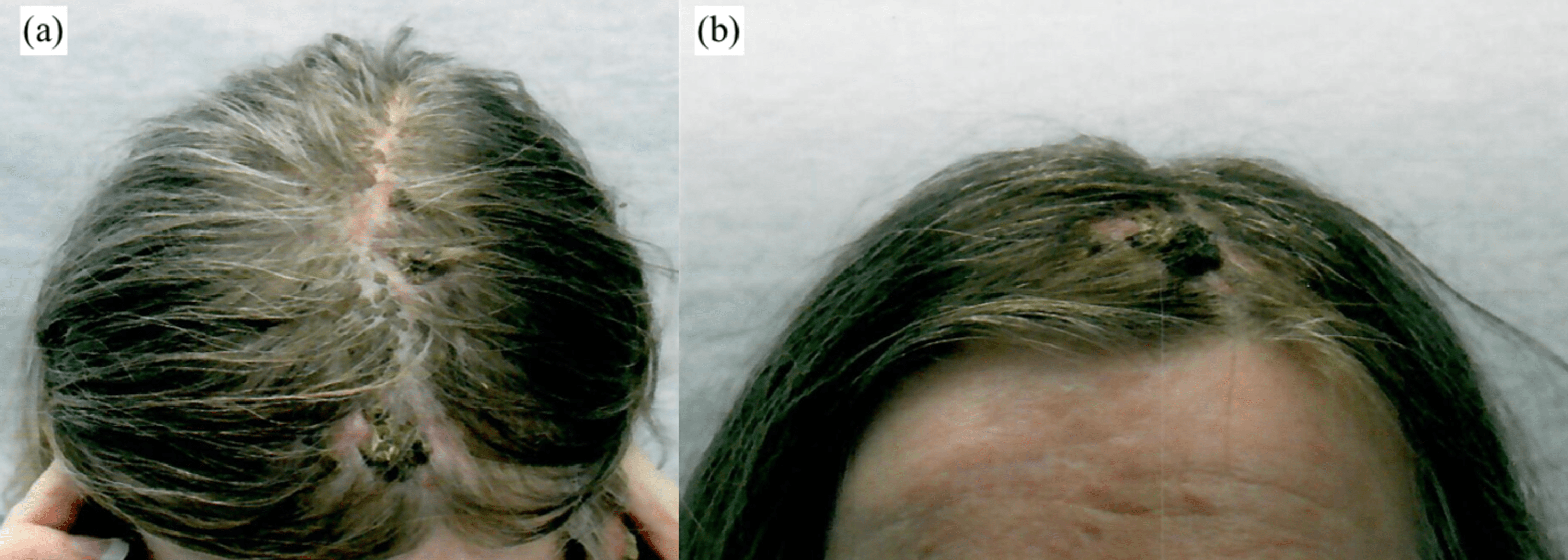 Cureus Large Scalp Defect Reconstruction With Tissue Expansion Orticochea Flap And Acellular