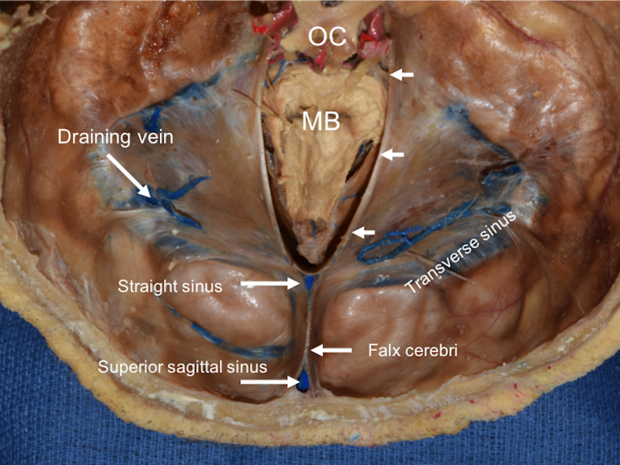 confluence of sinuses skull