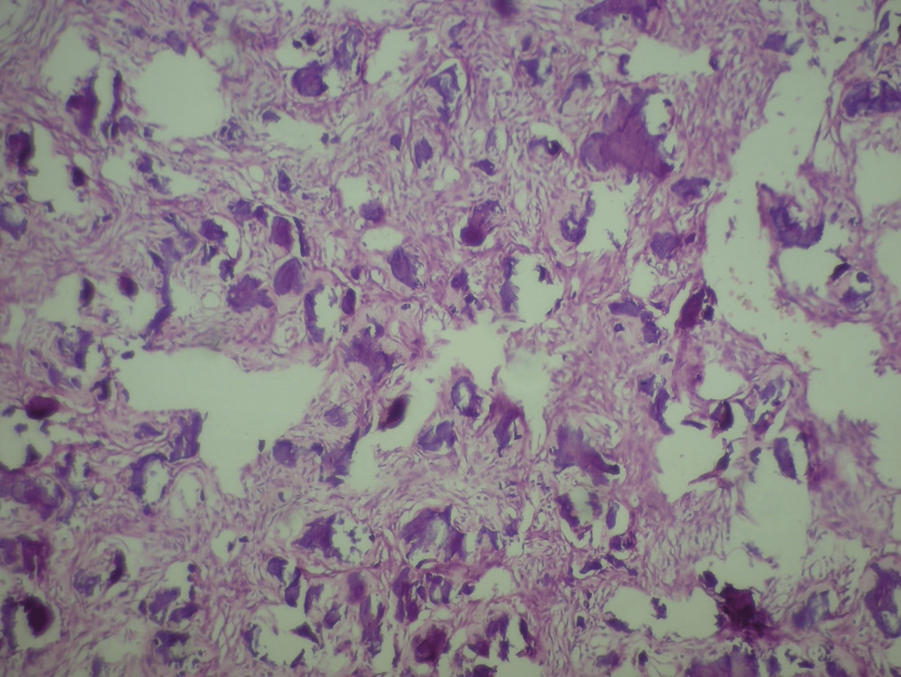 aneurysmal bone cyst jaw histology