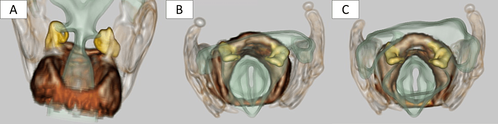 Laryngeal-three-dimensional-CT-scan