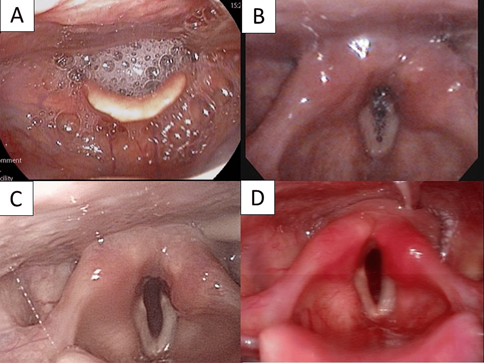 Progression-of-laryngeal-findings