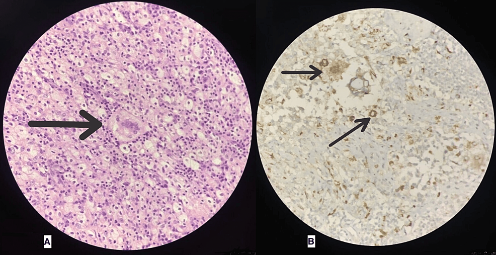 Immunohistochemistry-of-buccal-mucosa-specimen-showing-"Touton-giant-cells"-(A)-and-"CD68-cells"-(B)-consistent-with-adult-onset-xanthogranuloma