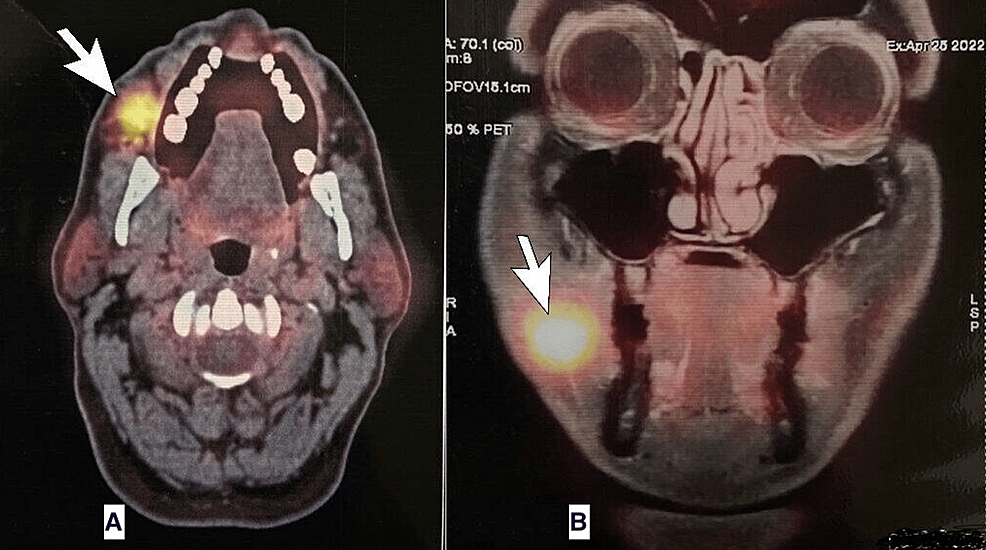 Positron-emission-tomography-CT-with-fusion-MRI-scan-of-the-head-showing-fluorodeoxyglucose-avid-lesions-in-right-buccal-mucosa-marked-by-white-arrows