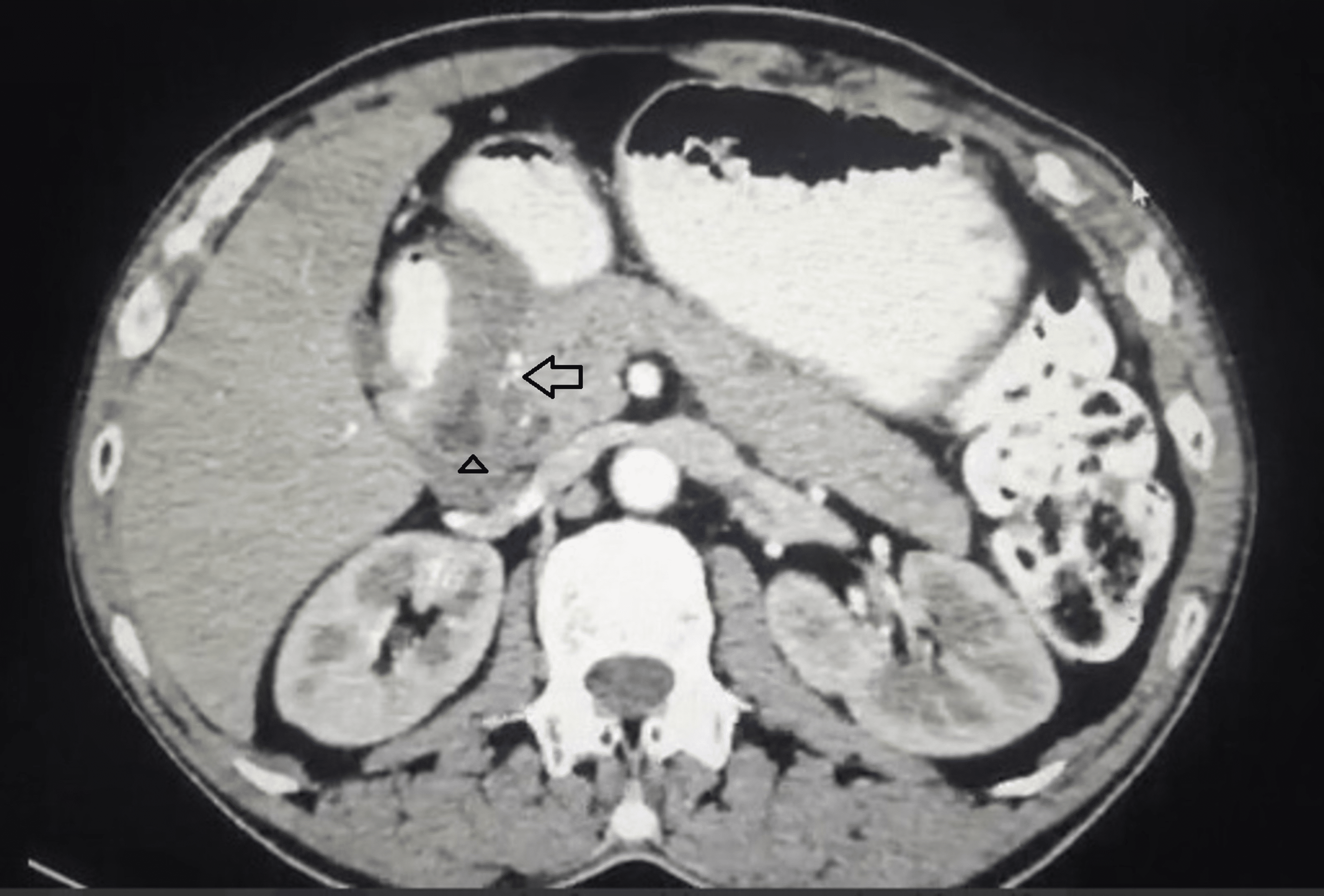 Cureus | Groove Pancreatitis: A Case Report and Review of a Hidden Type ...