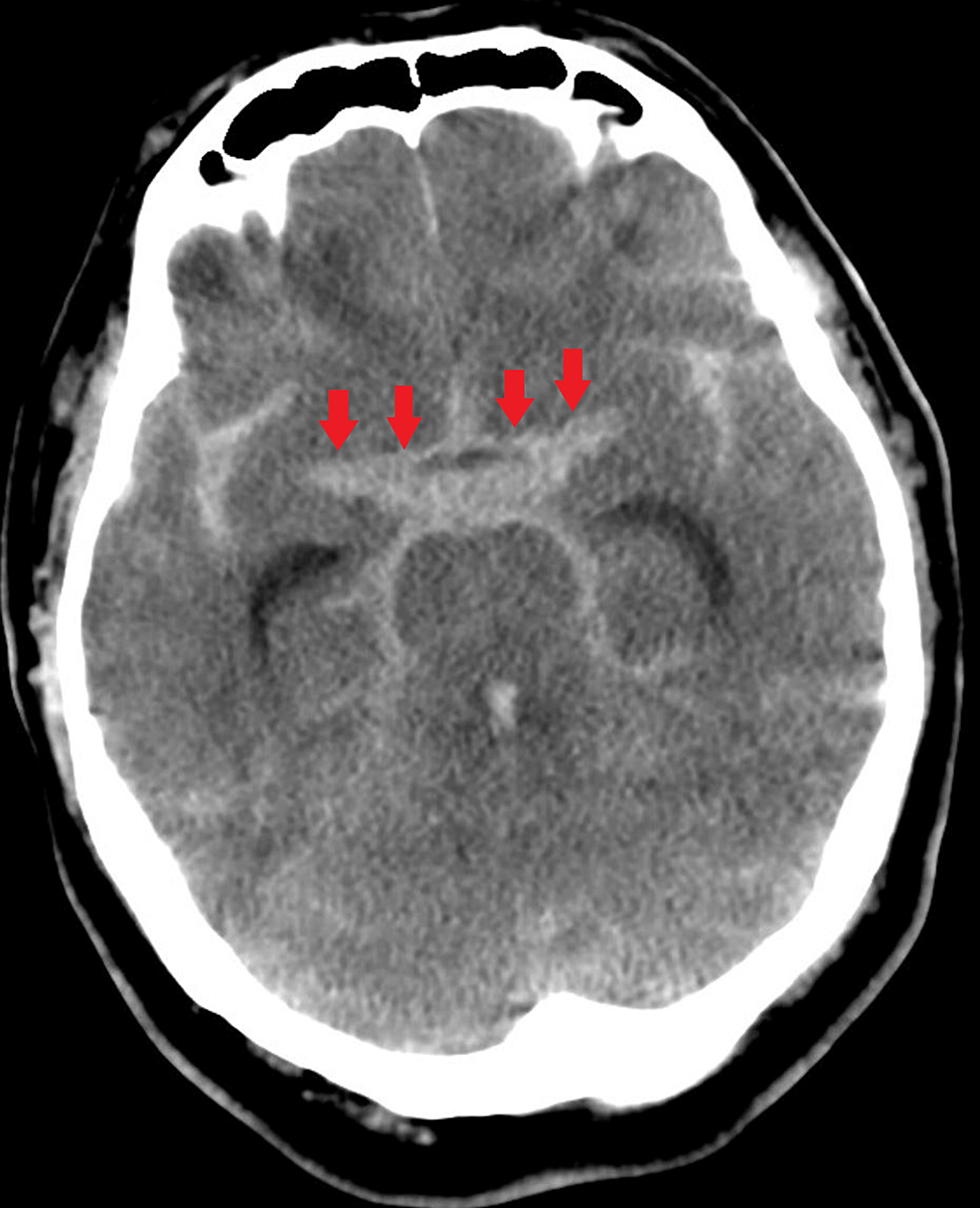 Cureus A Case Of Bilateral Vertebral Artery Dissecting Aneurysm Treated With Multimodality 9093