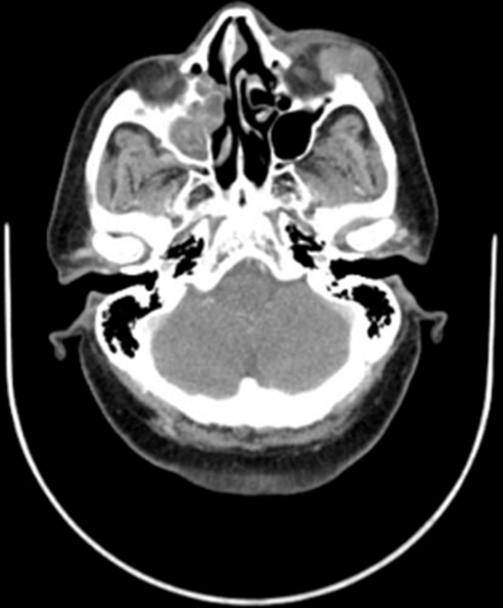 CT-axial-view-of-the-head-shows-the-subcutaneous-mass-overlying-the-left-maxillary-sinus-