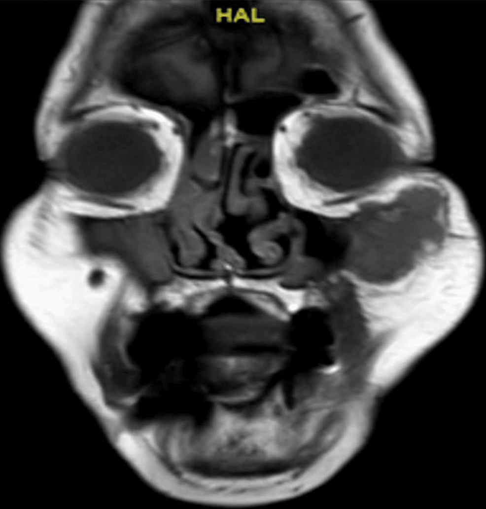 Head-MRI-shows-well-defined-lobulated-soft-tissue-mass-noted-at-the-anterior-left-cheek-subcutaneous-area,-with-low-to-iso-signal-intensity