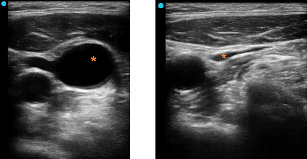 Cureus PointofCare Ultrasound Protocol for Insertion and