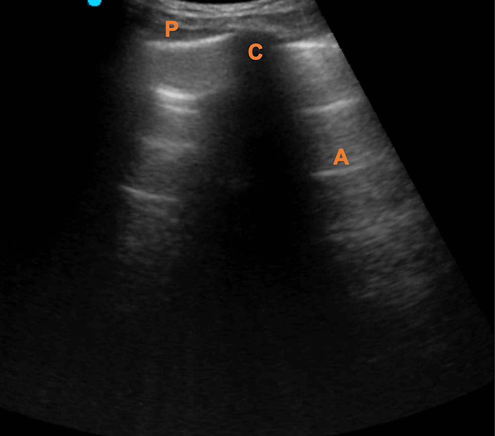 Point Of Care Ultrasound Protocol For Insertion And Confirmation