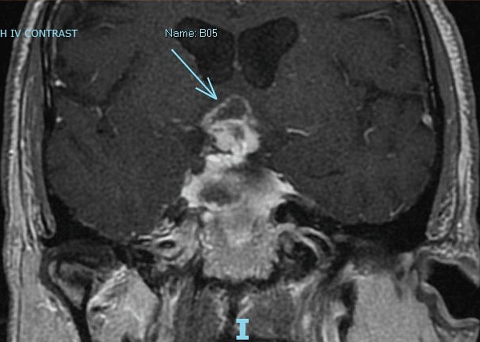 Sellar-mass-with-suprasellar-extension-(blue-arrow),-with-intrinsic-hemorrhagic-components-and-peripheral-enhancement.