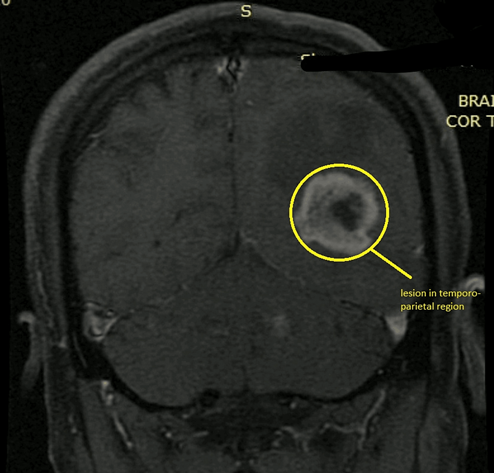 Coronal-view-of-the-MRI-showing-lesion-in-the-left-temporoparietal-region