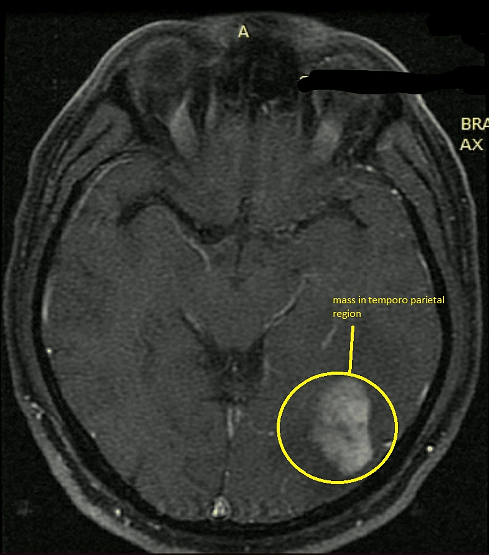 Axial-view-of-the-MRI-showing-lesion-in-the-left-temporoparietal-region
