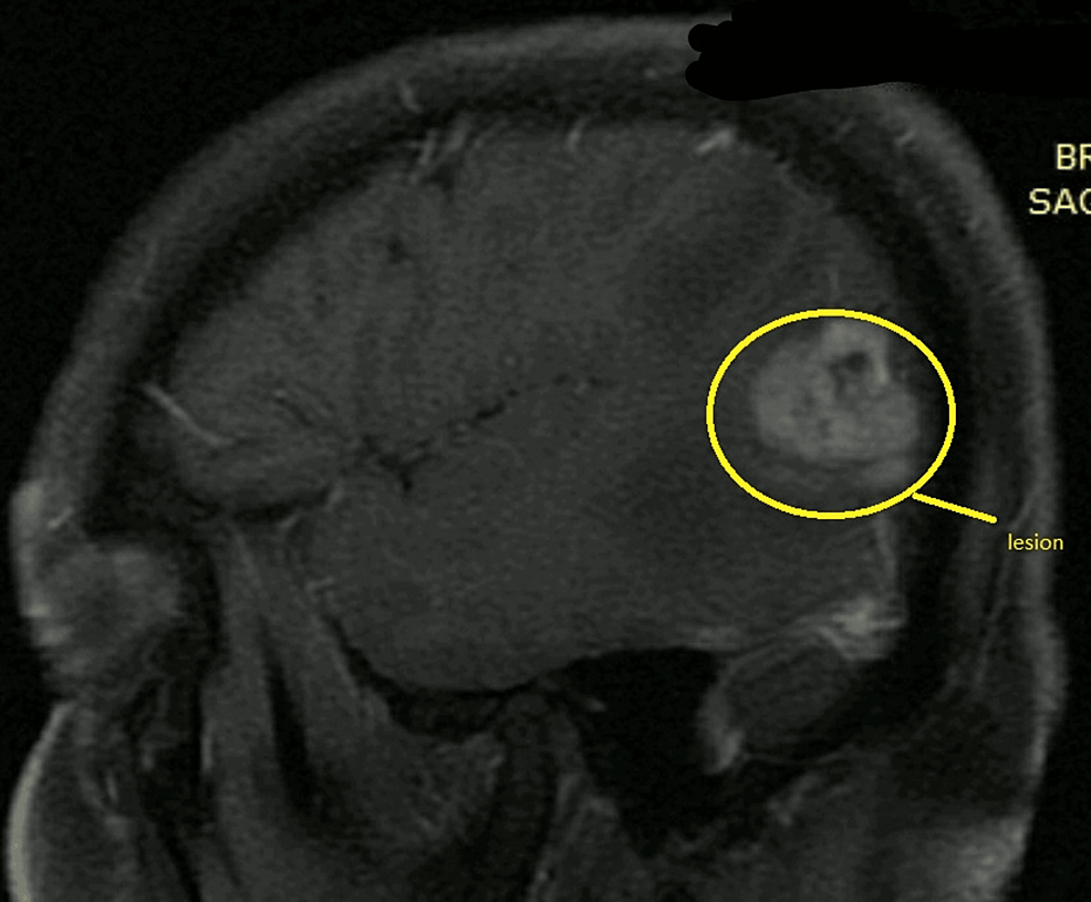 Sagittal-view-of-the-MRI-showing-lesion-in-the-left-temporoparietal-region