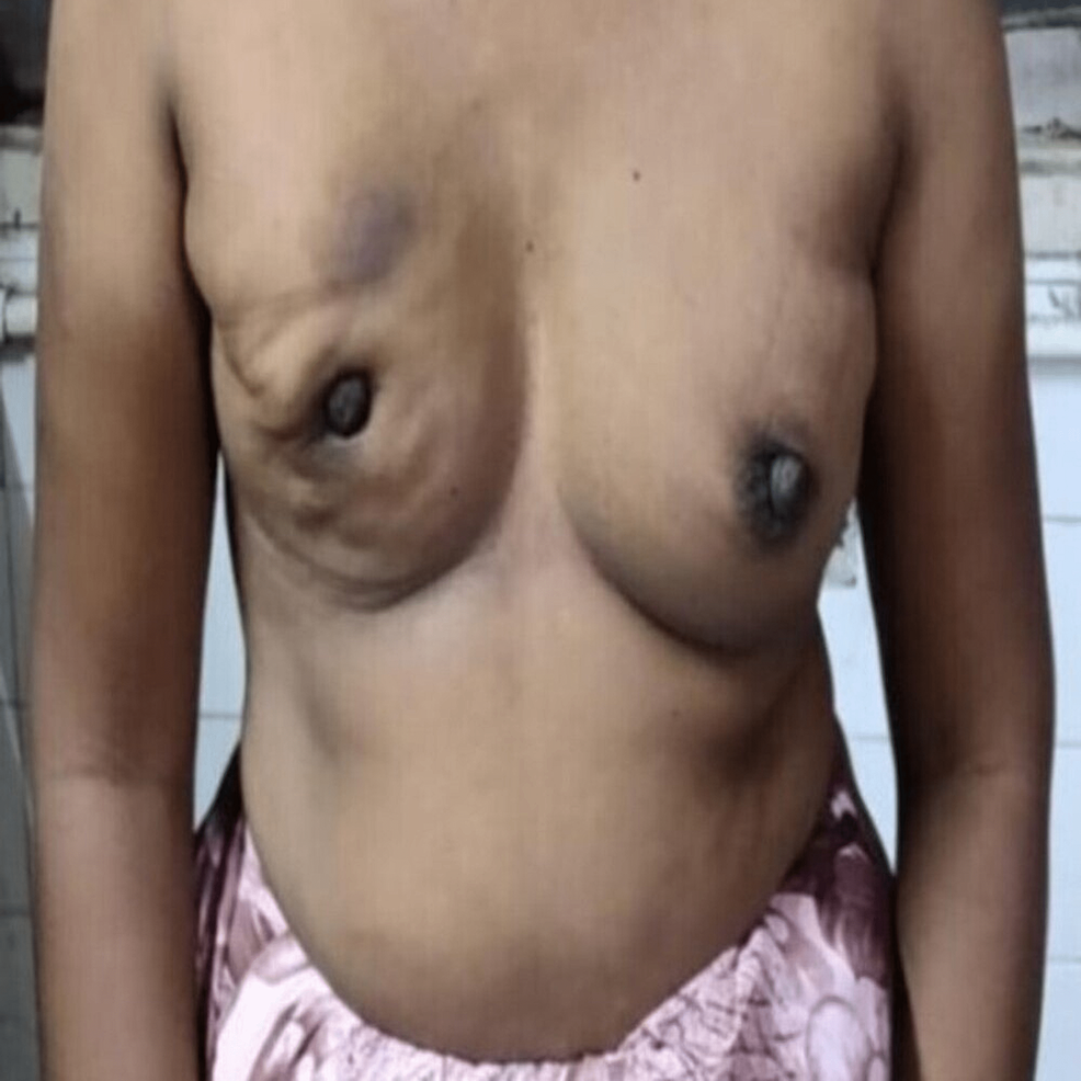 Clinical-photo-showing-retro-areolar-lump-and-circumferential-nipple-retraction-in-the-right-breast.-Puckering-is-also-seen-from-4-o'clock-to-10-o'clock-position-in-the-right-breast.