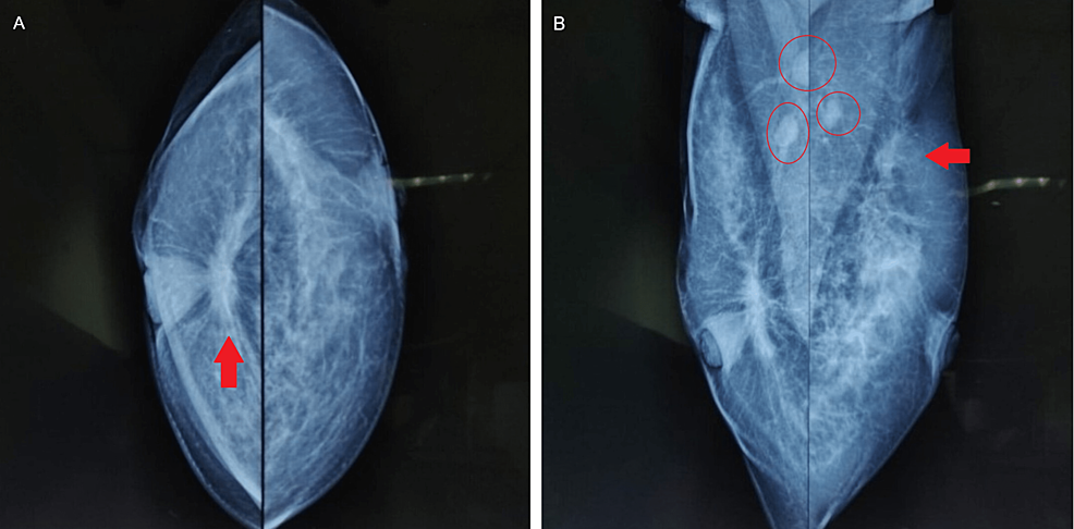 X-ray-mammogram-of-bilateral-breasts-with-the-axilla.-Arrow-(panel-A)-shows-the-retro-areolar-lesion-in-the-right-breast.-Arrow-(panel-B)-shows-the-hypoechoic-lesion-in-the-left-breast.-Circles-(panel-B)-shows-bilateral-lymphadenopathy.