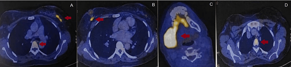 PET-CT-showing-metabolically-active-areas-(red-arrows).-A:-hypermetabolic-lesion-seen-in-the-left-breast-and-D5-vertebra.-B:-hypermetabolic-lesion-seen-in-the-retro-areolar-region-in-the-right-breast.-C:-hypermetabolic-lesion-seen-in-the-right-mandible.-D:-hypermetabolic-lesion-seen-in-D1-vertebra.