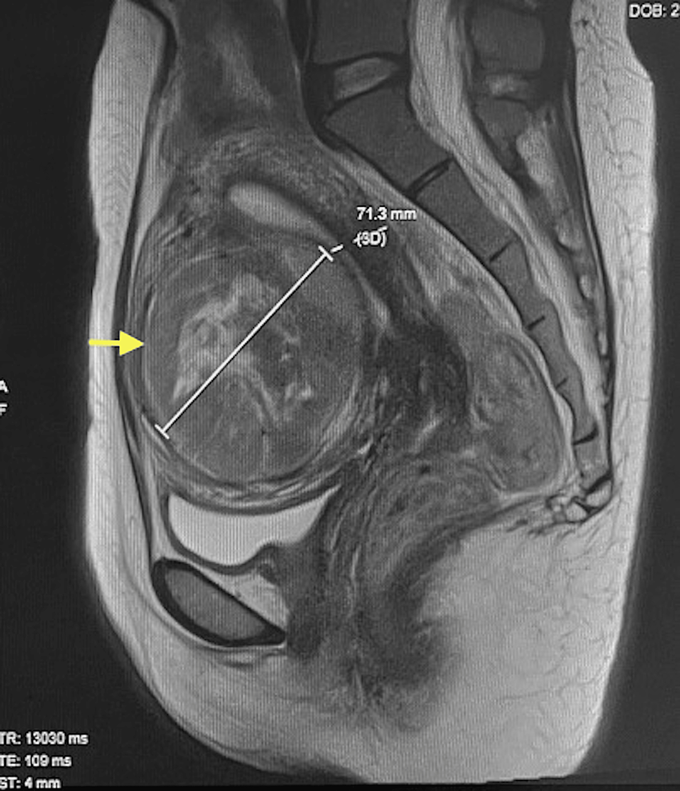 Effect of uterine fibroids (UFs) on heavy menstrual bleeding. The