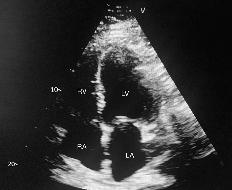 TTE-(apical-4-chamber-view)-showing-dilated-cardiac-chambers-including-mild-dilation-of-the-left-ventricle-(LV),-right-atrium-(RA),-and-right-ventricle-(RV),-and-moderate-dilation-of-the-left-atrium-(LA).-The-ejection-fraction-was-estimated-at-10%-with-severely-impaired-left-ventricular-systolic-function,-impaired-right-ventricular-systolic-function,-and-grade-three-diastolic-dysfunction.-