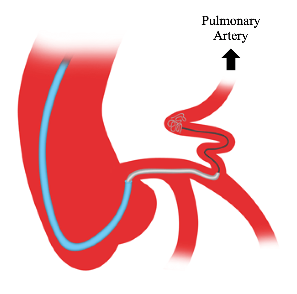 CoronaryPulmonary Artery Fistula Repair With Coil Embolization A