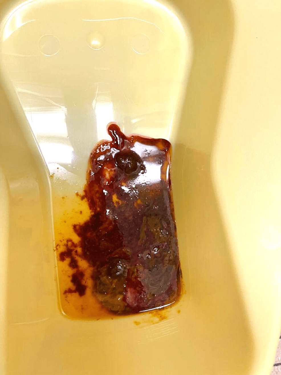 Pictures Of Blood In Stool