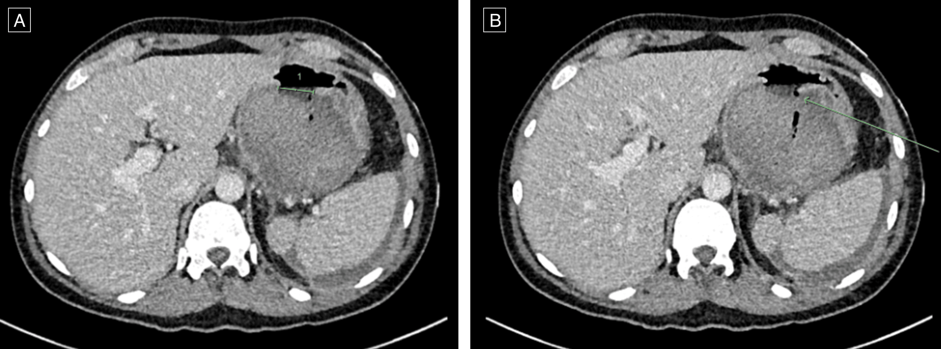 Cureus | Spontaneous Cystogastrostomy: A Natural Response