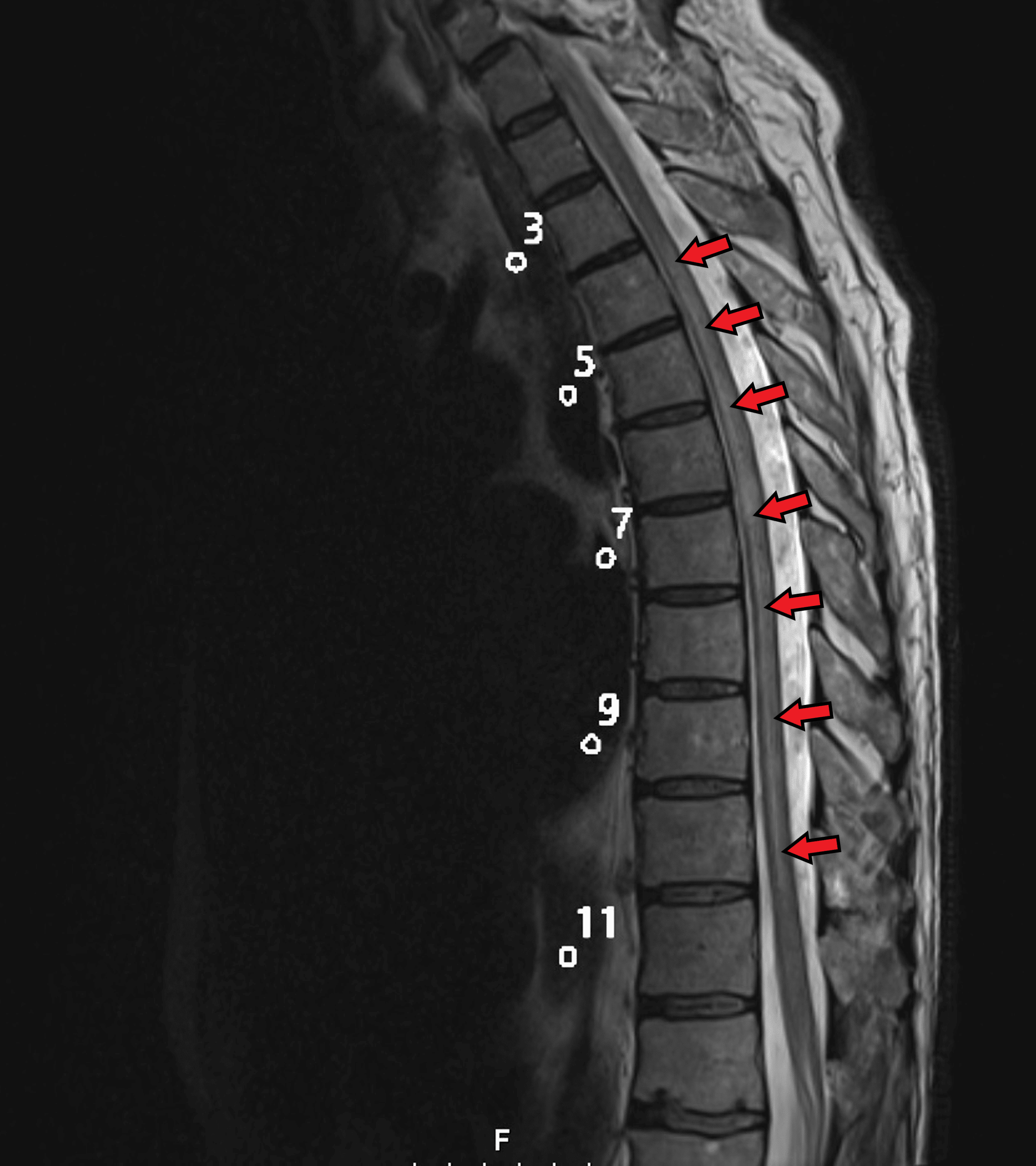 Cureus | Two Case Reports of Patients With Transverse Myelitis as a ...