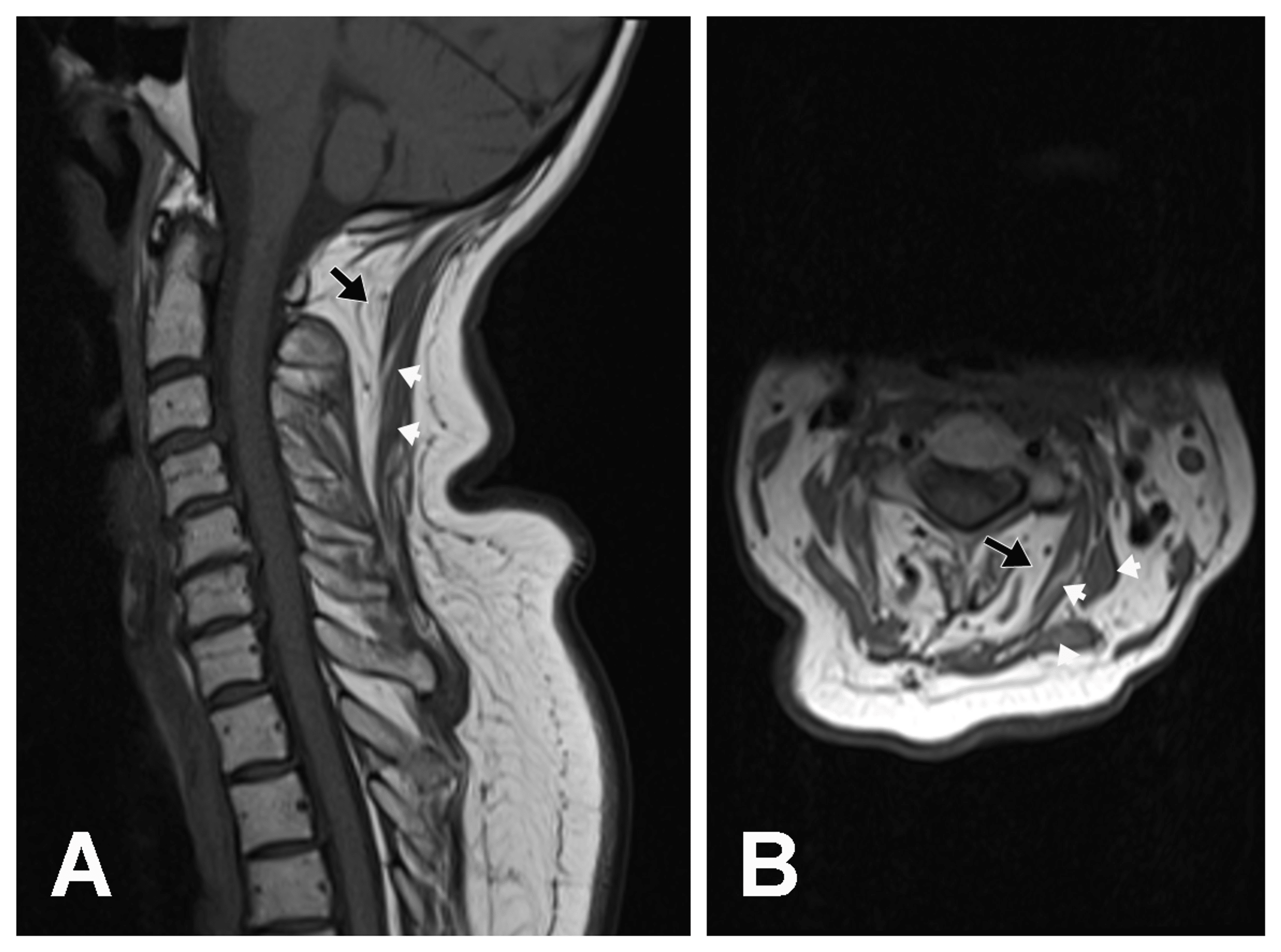 Cureus EarlyOnset Dropped Head Syndrome and PersonintheBarrel