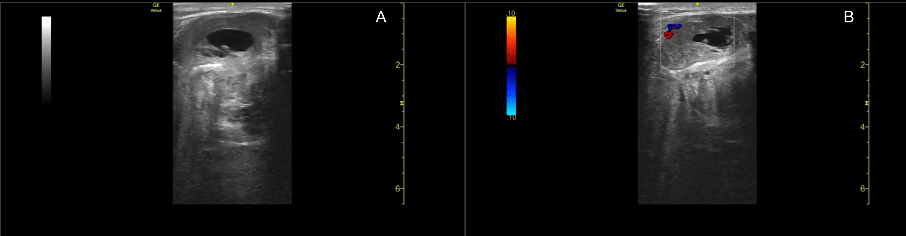 Cureus Use of Ultrasound for Evaluation of a Large Undifferentiated