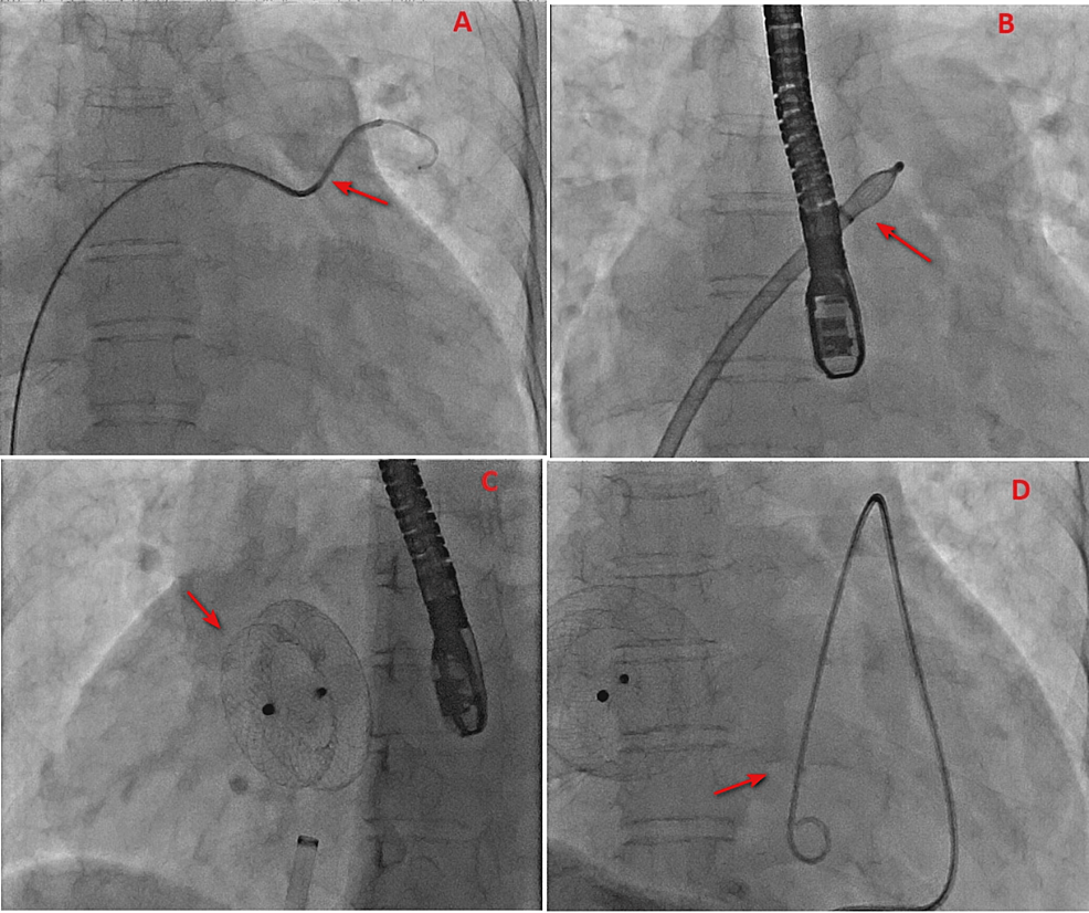 Fluoroscopy-during-the-procedure