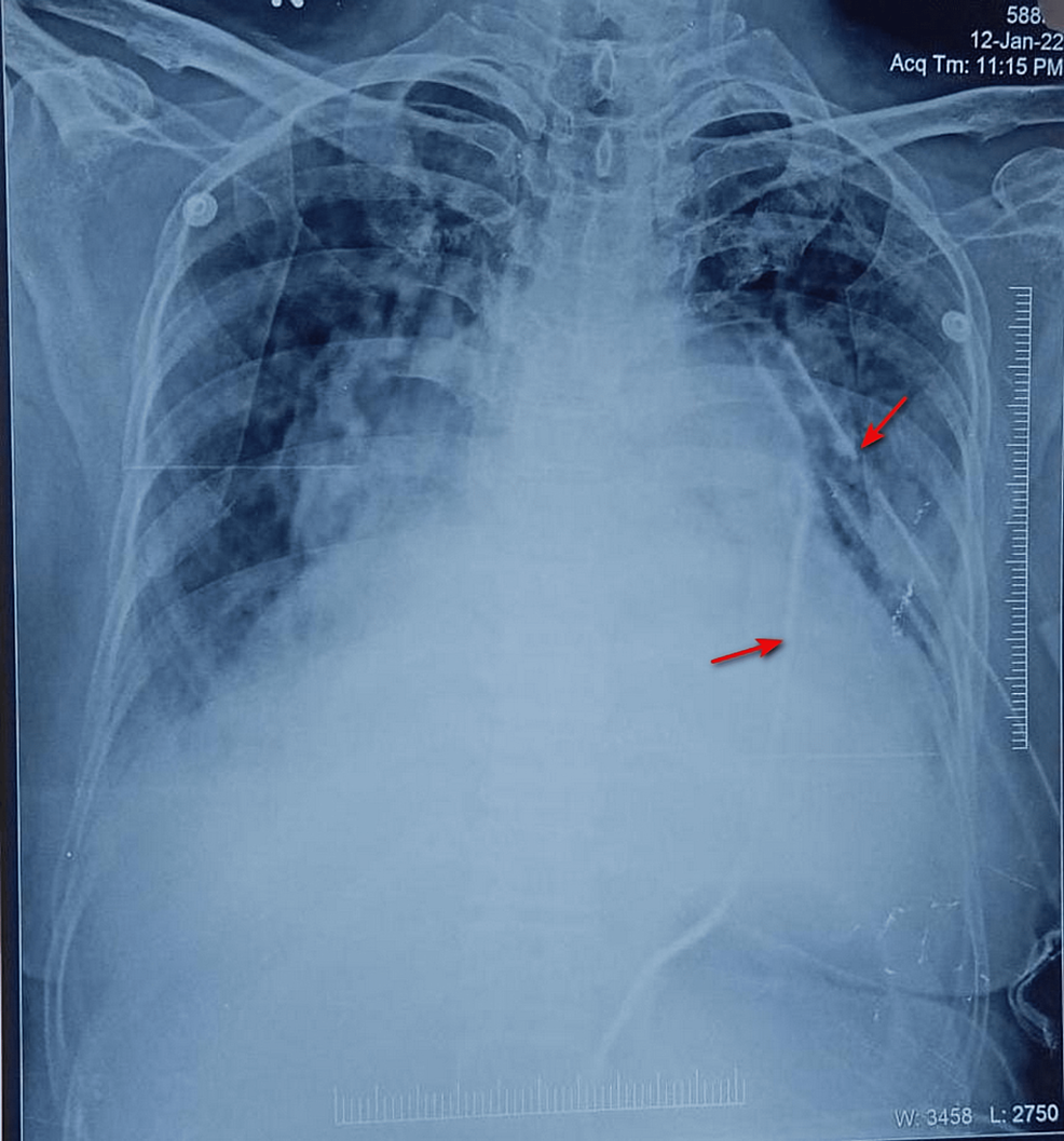 Chest X-ray after transcatheter closure of the atrial septal defect