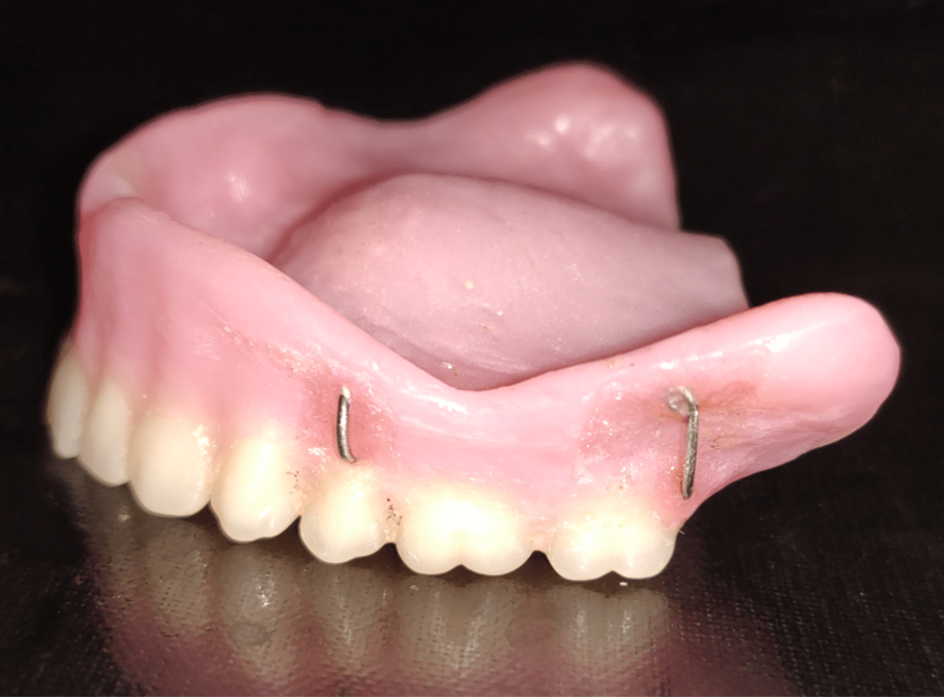 Cureus Enhancing Esthetics in a Complete Denture Patient Optimizing