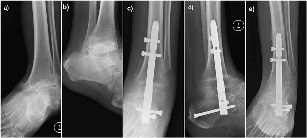 Radiological-images-of-Case-1.-(a)-and-(b):-Preoperative-AP-and-lateral-radiographs-of-a-59-year-old-gentleman-with-severe-Cavovarus-osteoarthritis-secondary-to-Charcot-Marie-Tooth-disease;-(c)-and-(d):-Postoperative-AP-and-lateral-radiographs-showing-that-the-alignment-of-the-hindfoot-nail-being-centre-centre-on-both-views;-(e)-AP-radiograph-showing-a-periprosthetic-fracture-when-he-lightly-knocked-his-leg-against-a-worktable-