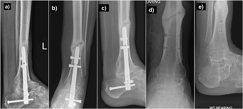 Radiological-images-of-Case-1.-(a)-lateral-radiograph-showing-a-periprosthetic-fracture-when-he-lightly-knocked-his-leg-against-a-worktable;-(b)-and-(c):-AP-and-lateral-radiographs-showing-a-further-periprosthetic-fracture-over-healing-callus;-(d)-and-(e):-AP-and-lateral-radiographs-following-elective-nail-removal