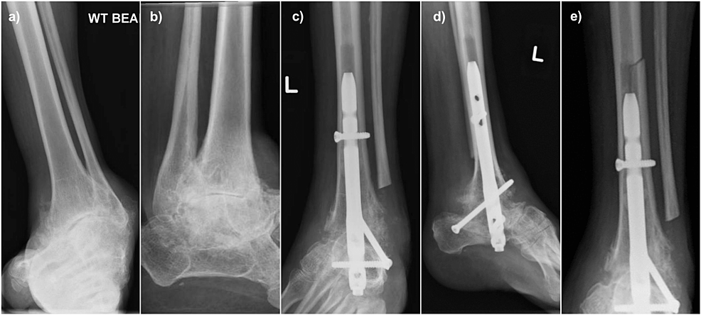 Radiological-images-of-Case-2.-(a)-and-(b):-Preoperative-AP-and-lateral-radiographs-of-a-60-year-old-gentleman-with-severe-Cavovarus-osteoarthritis-secondary-to-Charcot-Marie-Tooth-disease;-(c)-and-(d)-Postoperative-AP-and-lateral-radiographs-showing-that-the-alignment-of-the-hindfoot-nail-being-centre-centre-on-both-views;-(e)-AP-radiograph-showing-that-the-periprosthetic-fracture-after-the-twisting-injury--