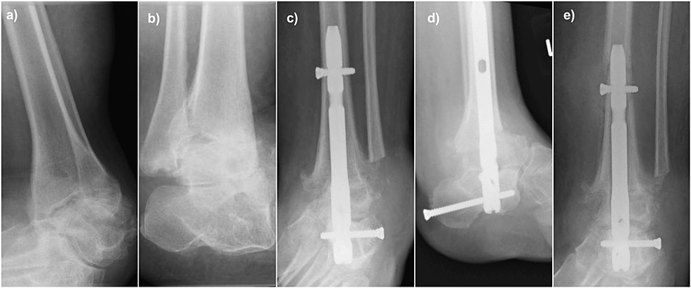 Radiological-images-of-Case-3.-(a)-and-(b):-Preoperative-AP-and-lateral-radiographs-of-a-53-year-old-lady-with-severe-Cavovarus-osteoarthritis-secondary-to-Charcot-Marie-Tooth-disease;-(c)-and-(d)-Postoperative-AP-and-lateral-radiographs-showing-that-the-alignment-of-the-hindfoot-nail-being-centre-centre-on-both-views;-(e)-AP-radiograph-showing-a-displaced-periprosthetic-fracture-following-no-history-of-trauma-