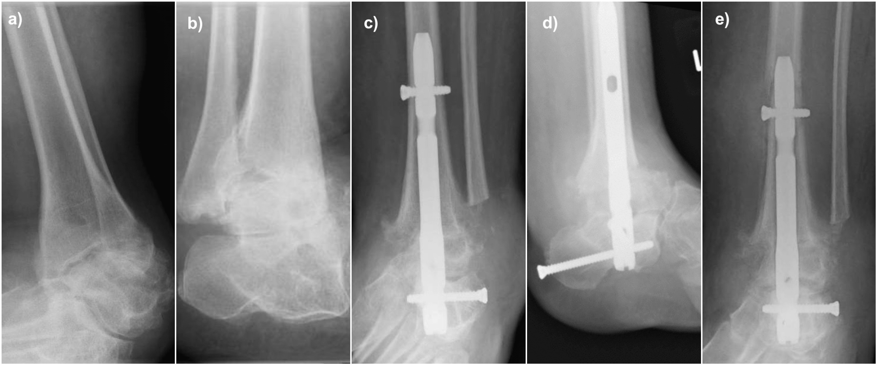 Cureus | Charcot-Marie-Tooth Disease as a Risk Factor for Periprosthetic  Fractures in Tibiotalocalcaneal Fusion With Intramedullary Nailing | Article