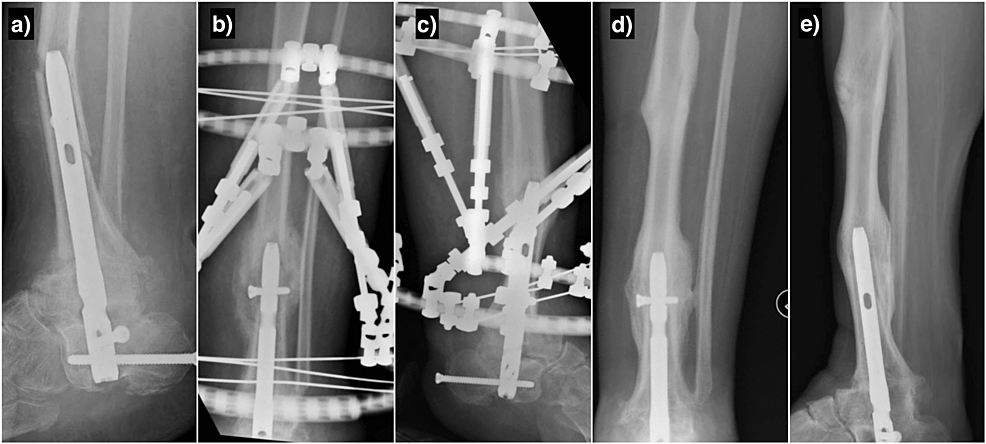 Radiological-images-of-Case-3.-(a)-Lateral-radiograph-showing-a-displaced-periprosthetic-fracture-following-no-history-of-trauma;-(b)-and-(c):-AP-and-lateral-radiographs-showing-the-periprosthetic-fracture-treated-with-a-Taylor-Spatial-Frame;-(d)-and-(e):-AP-and-lateral-showing-the-healing-of-both-periprosthetic-fractures-following-conservative-management