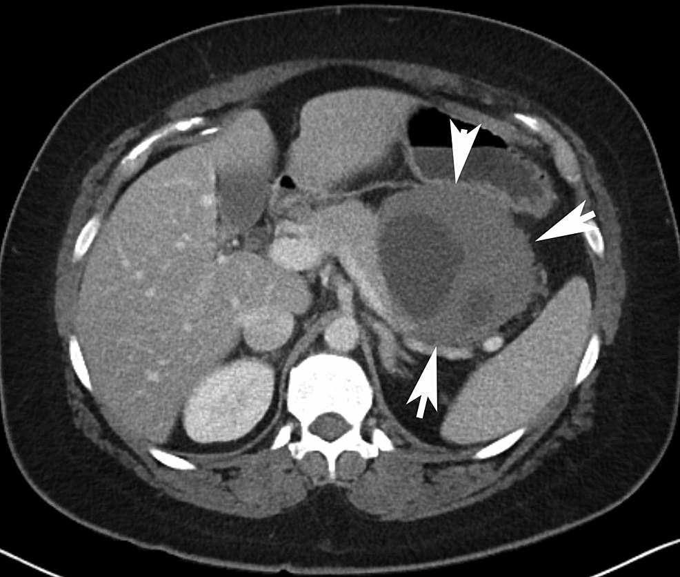 Biclonal Desmoid-Type Fibromatosis With Two Beta-Catenin Mutations ...