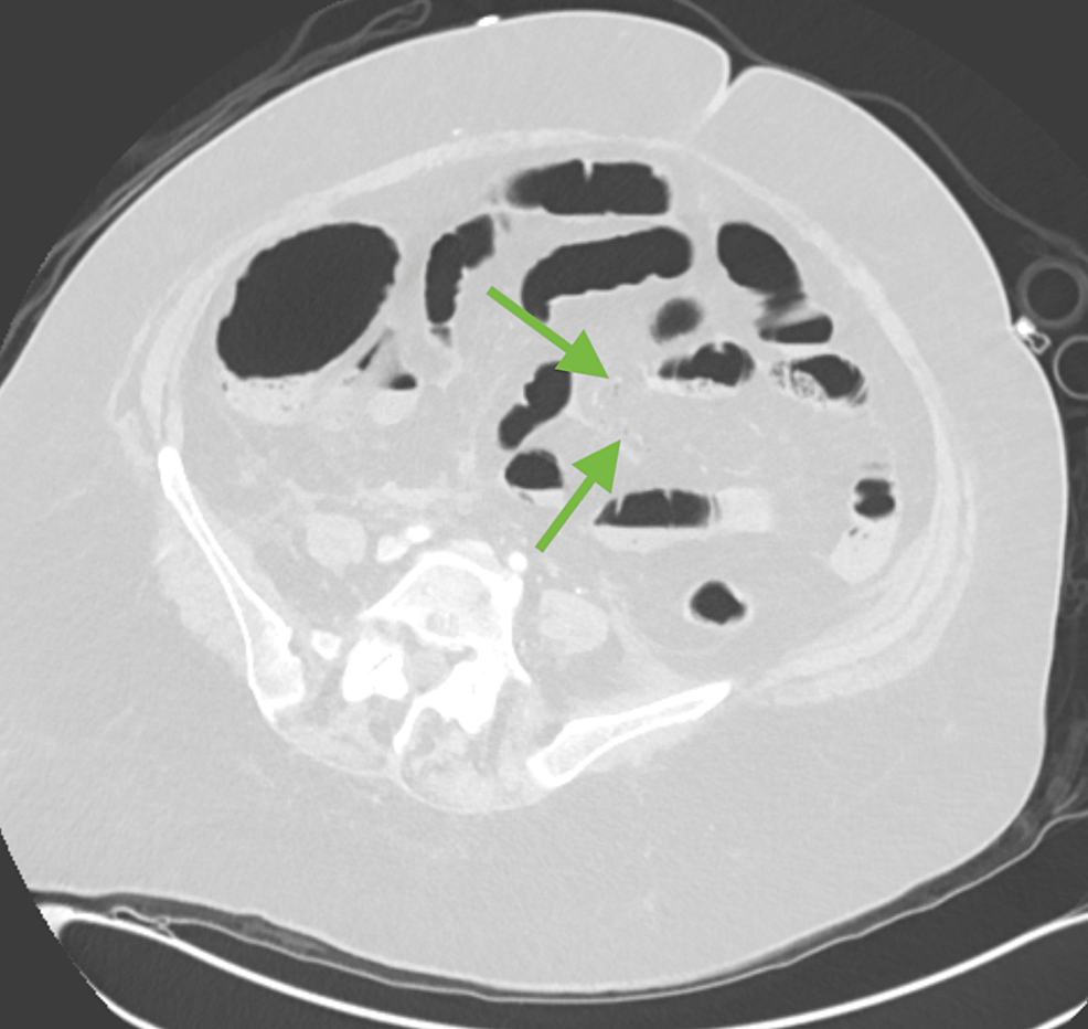 Axial-lung-window-demonstrating-very-subtle-mesenteric-vein-air- (green arrow).